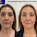 DNA ROYAL Thane: The Best Clinic for Treating Deep Wrinkles on the Face.